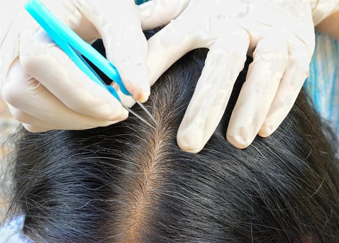 白頭發(fā)拔一根長三根？到底能不能拔？終于弄清楚了