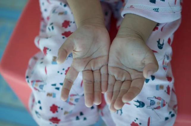 關(guān)于手足口病的8個常見誤區(qū),一次說清!