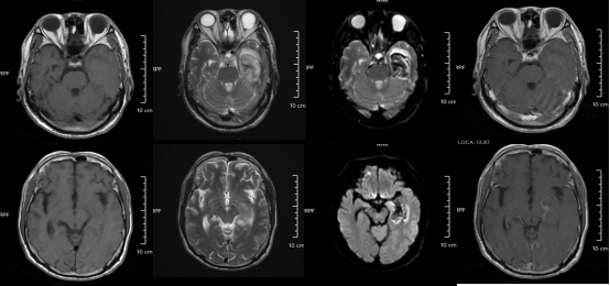 30歲小伙長期熬夜智力退回3歲 年輕人患“腦膜炎”病例為何頻發？